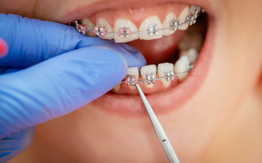 What Is the Best Age to Get Braces? | Bennion Lambourne Orthodontics