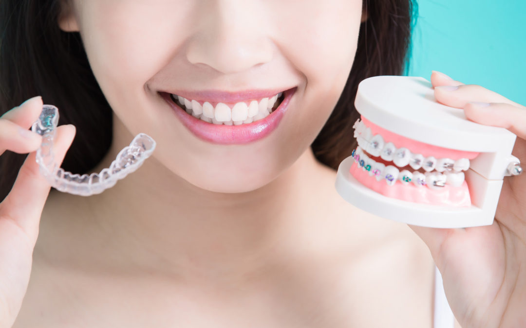 Invisalign vs Braces: How to Know What Is Best for You