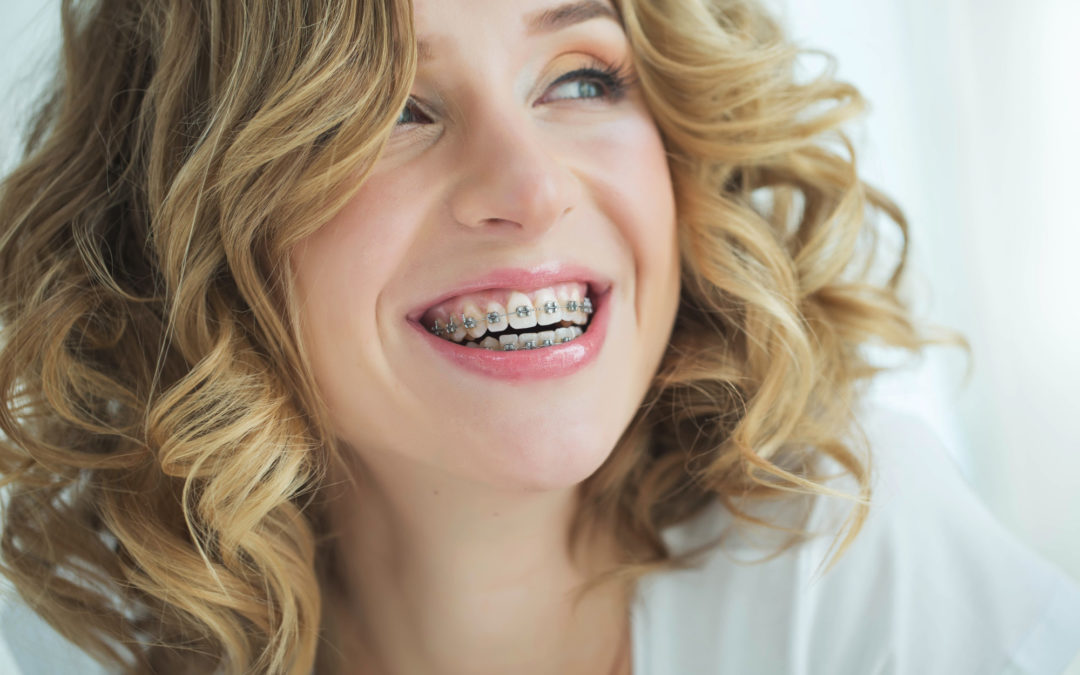 How to Best Prepare For Getting Braces