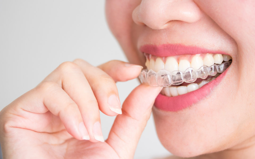 The Incredible Benefits of Invisalign Braces