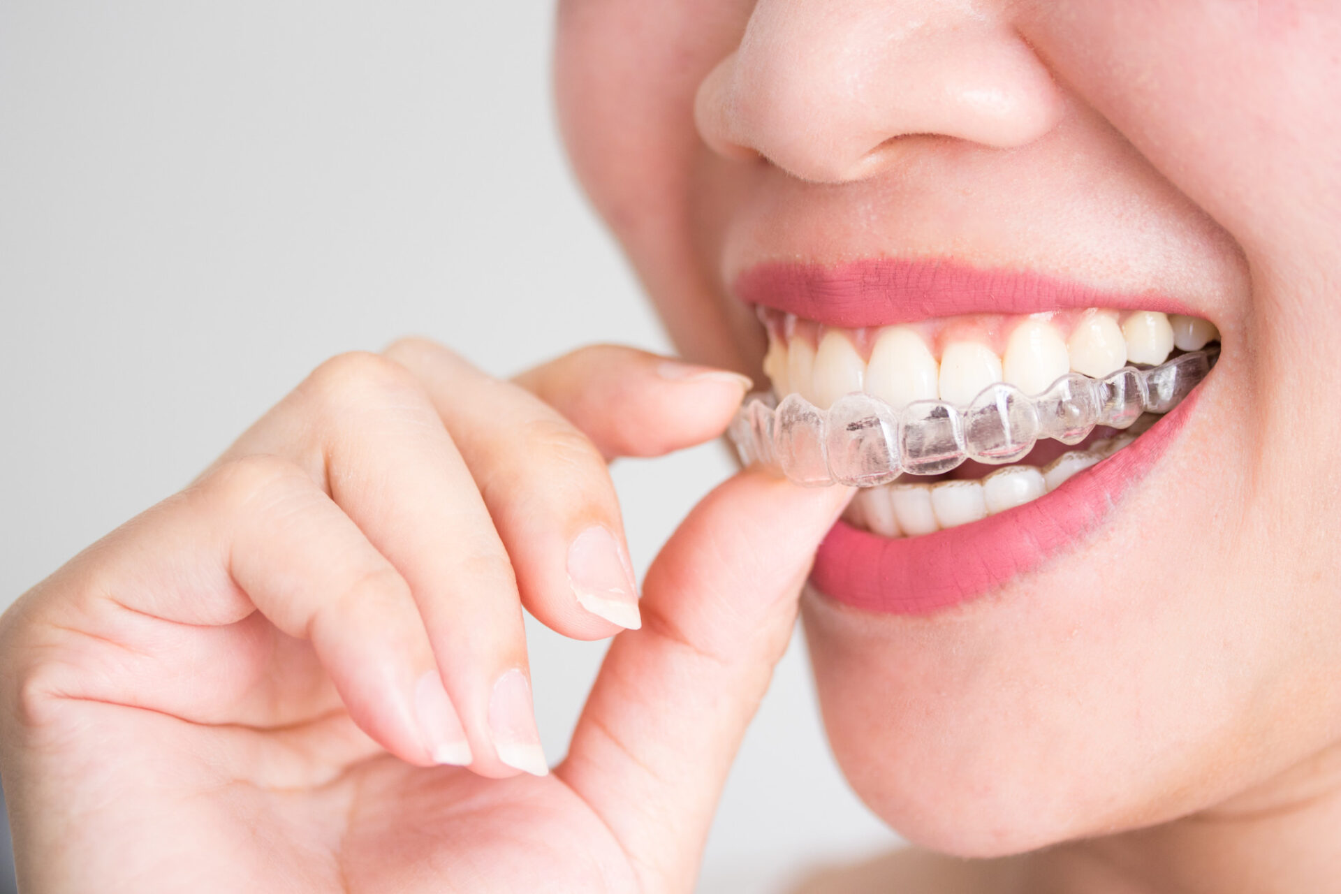 The Incredible Benefits of Invisalign Braces -
