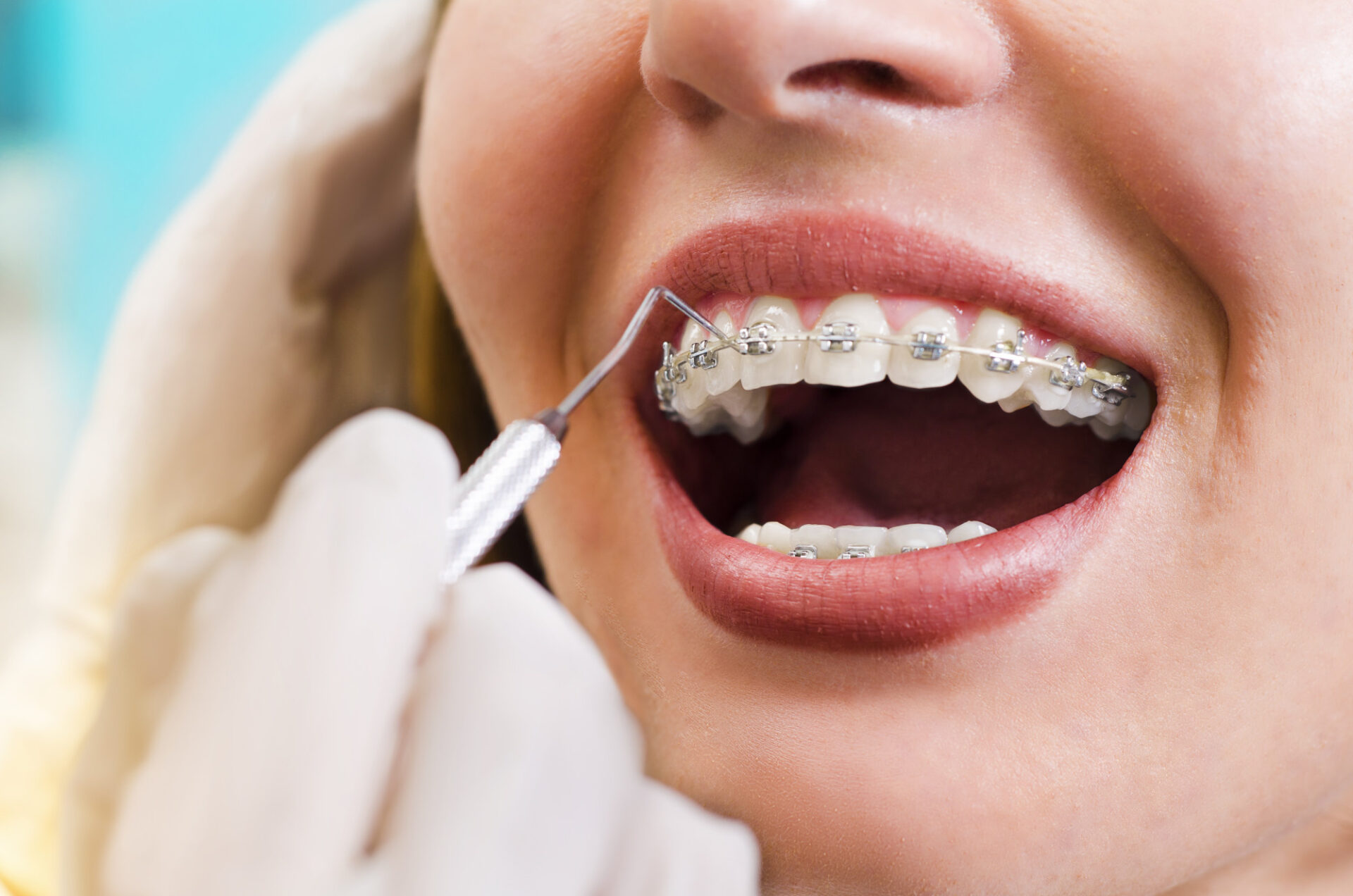 Perfect Smiles: 7 Simple Advantages of Metal Braces 