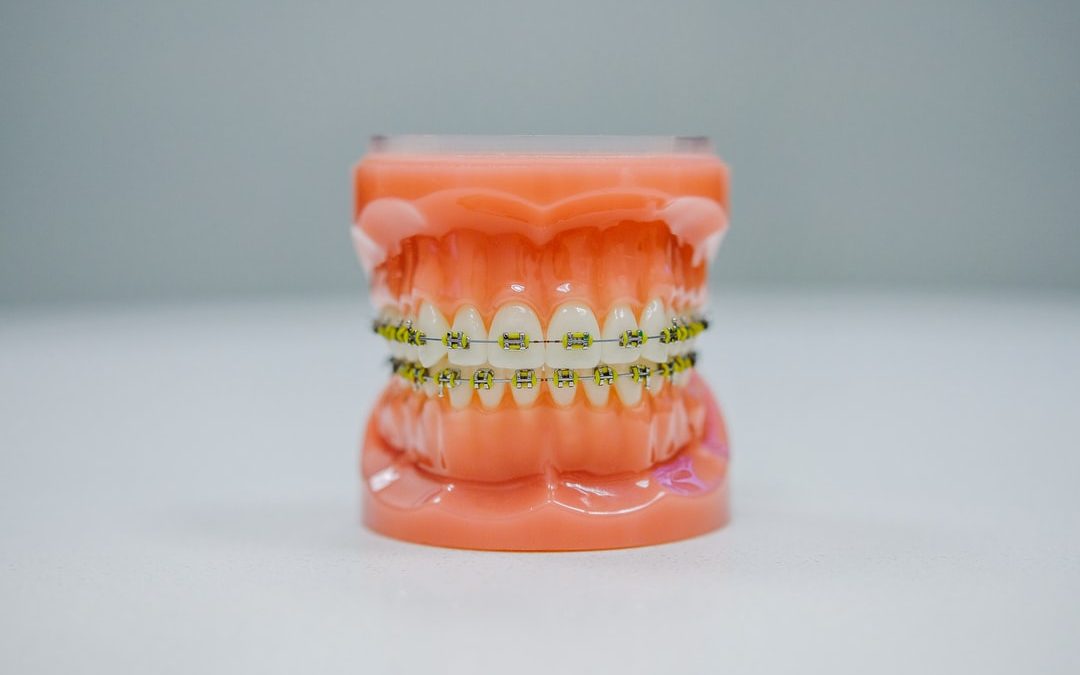What Is Open Bite and How Can Braces Help?