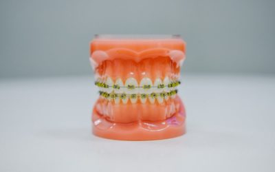 What Is Open Bite and How Can Braces Help?