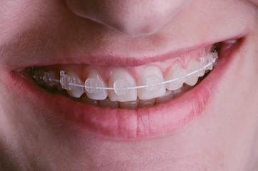 ceramic braces