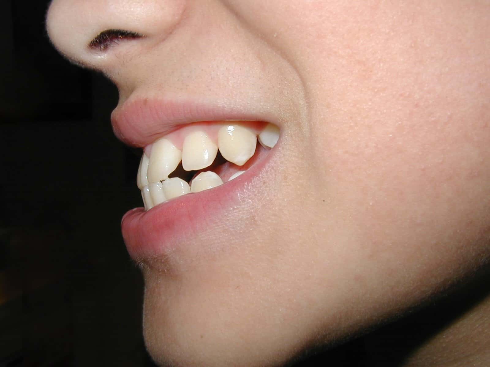 what causes overbites